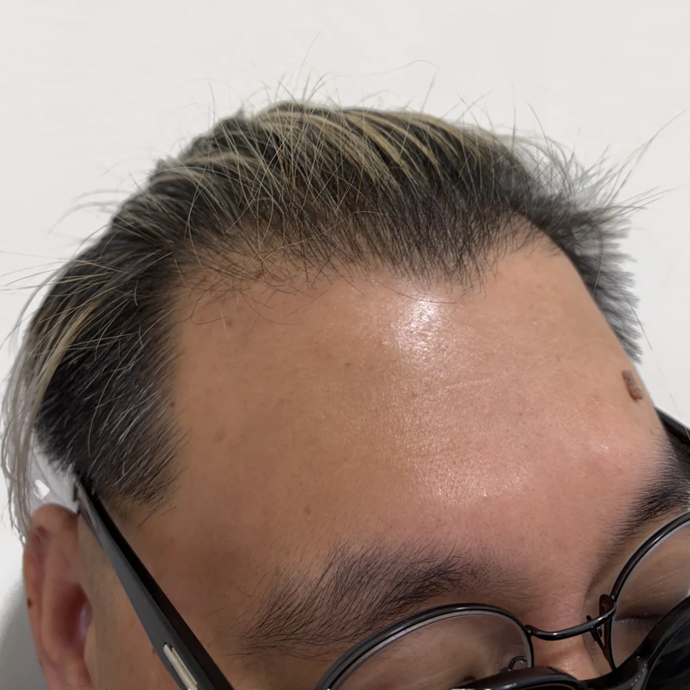 男士髮線・操作前