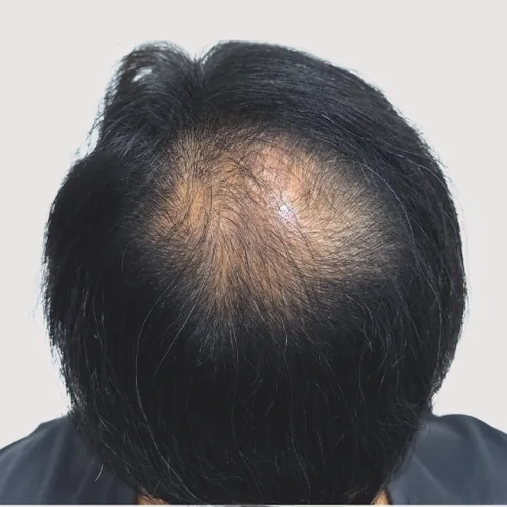 男士頭頂・操作前